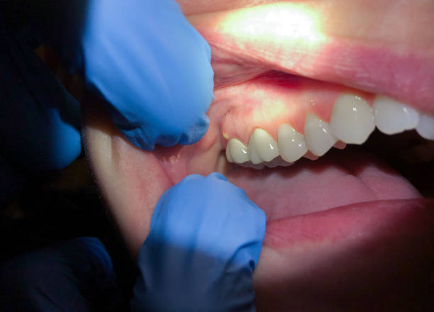 Best Emergency Treatment for Toothache in Fox Point, WI
